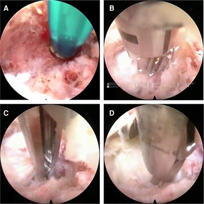 A Novel Trajectory for a Transpedicular Approach in the Treatment of a Highly Downward-Migrated Lumbar Herniation with a Full Endoscopic Technique